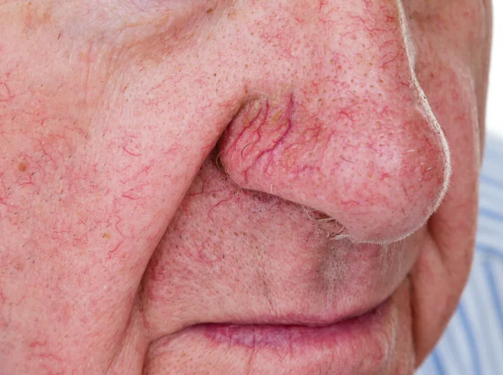 What’s the Easiest Way to Get Rid of Spider Veins on the