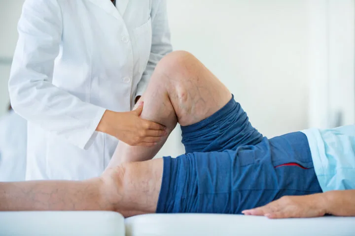 Can Varicose Veins Be A Sign Of Stroke Risk?