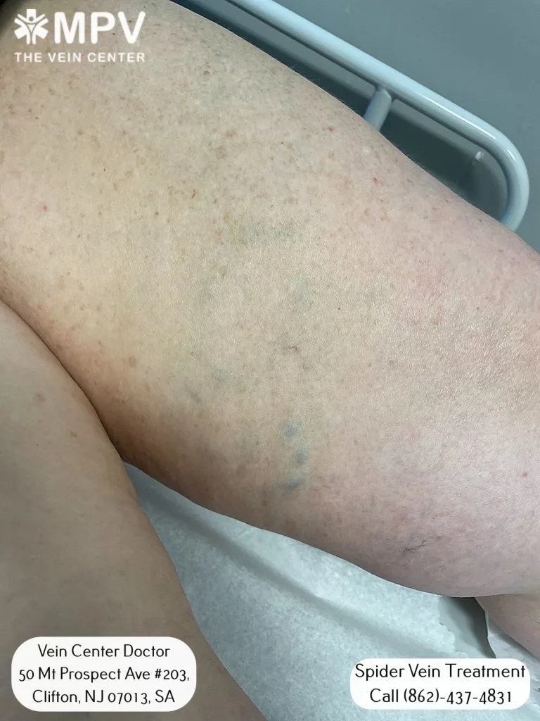 thread vein removal treatments at Vein Center Doctor
