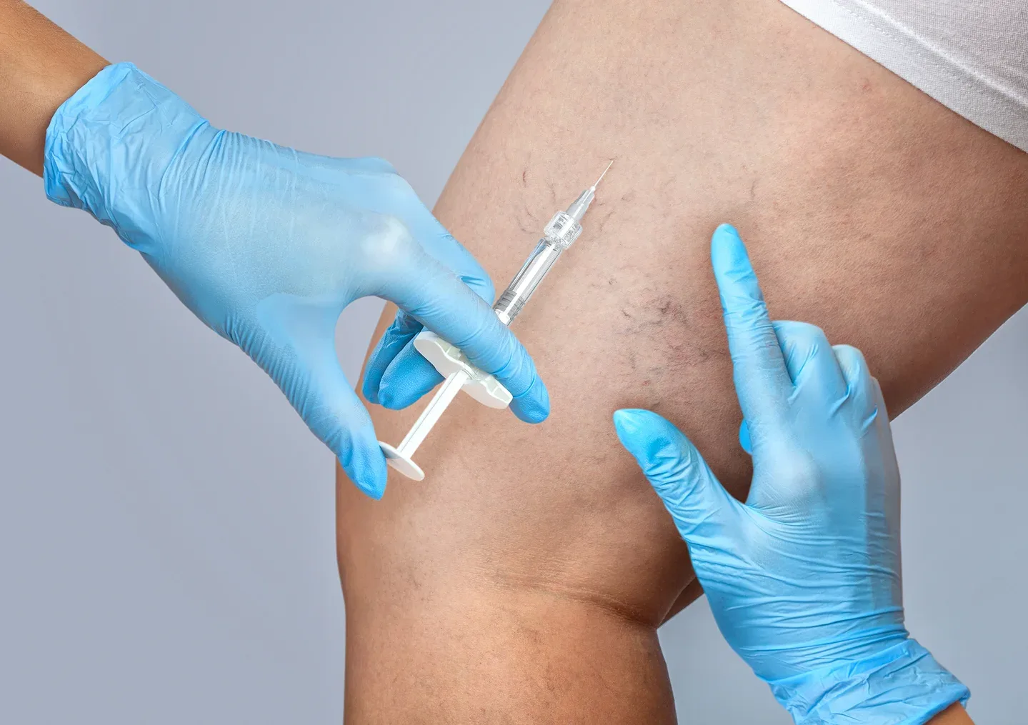 Best Thread Vein Removal Treatments
