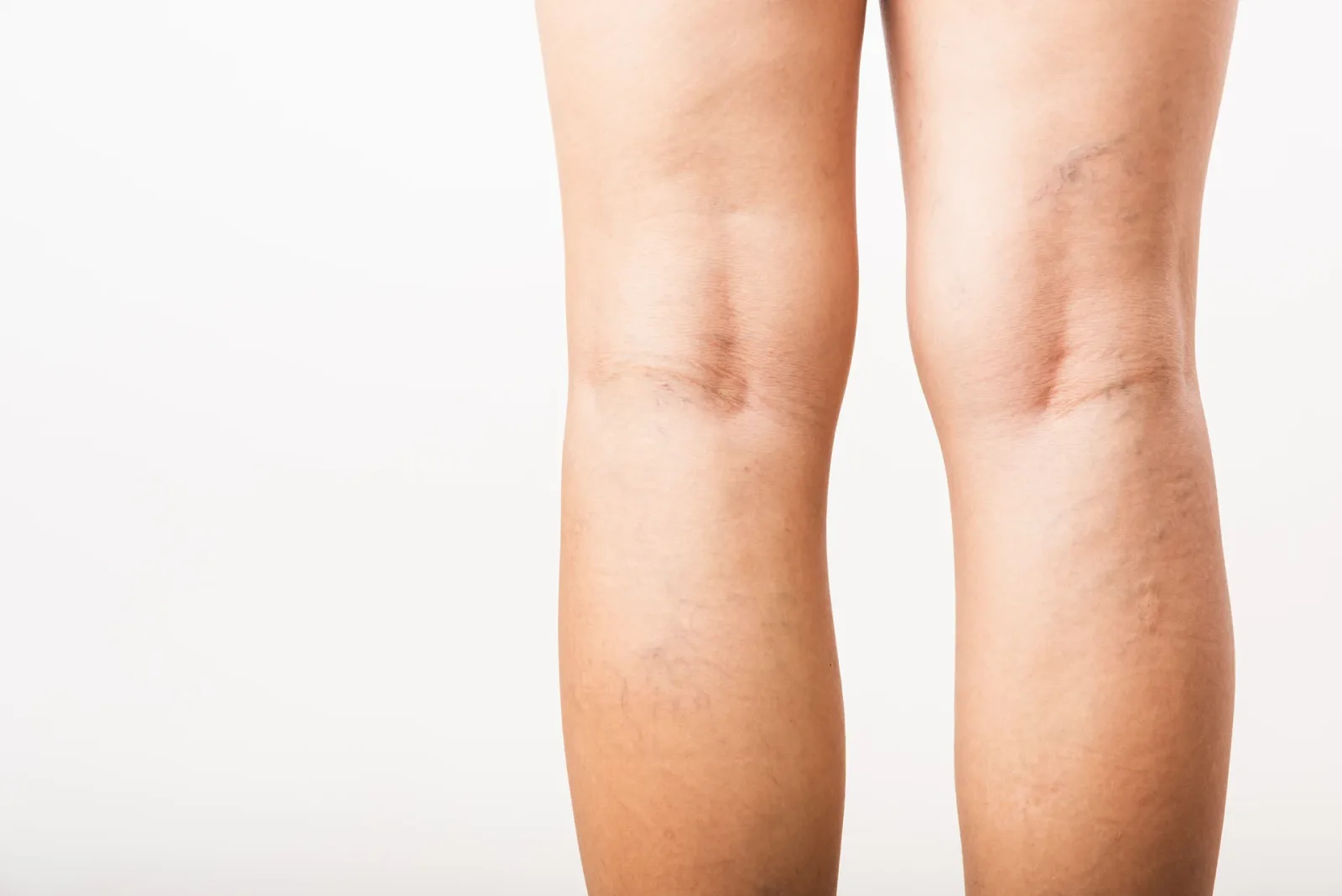 Can Venous Insufficiency Become Chronic?