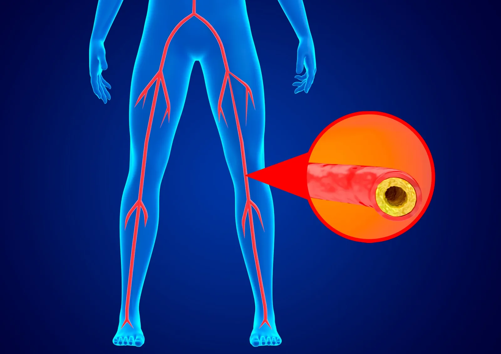 Chronic Venous Insufficiency vs Peripheral Arterial