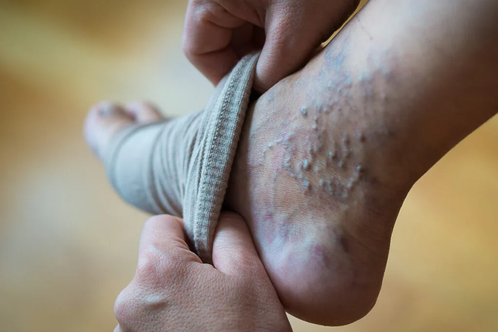 person puts compression socks on her foot full of varicose and spider veins to heal
