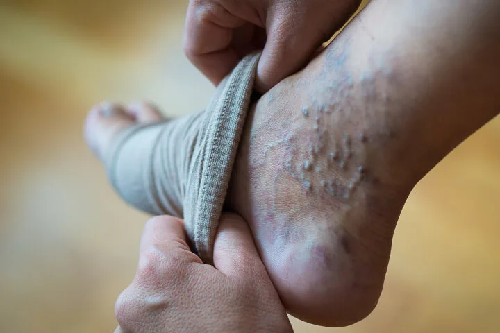 compression stockings for spider and varicose veins