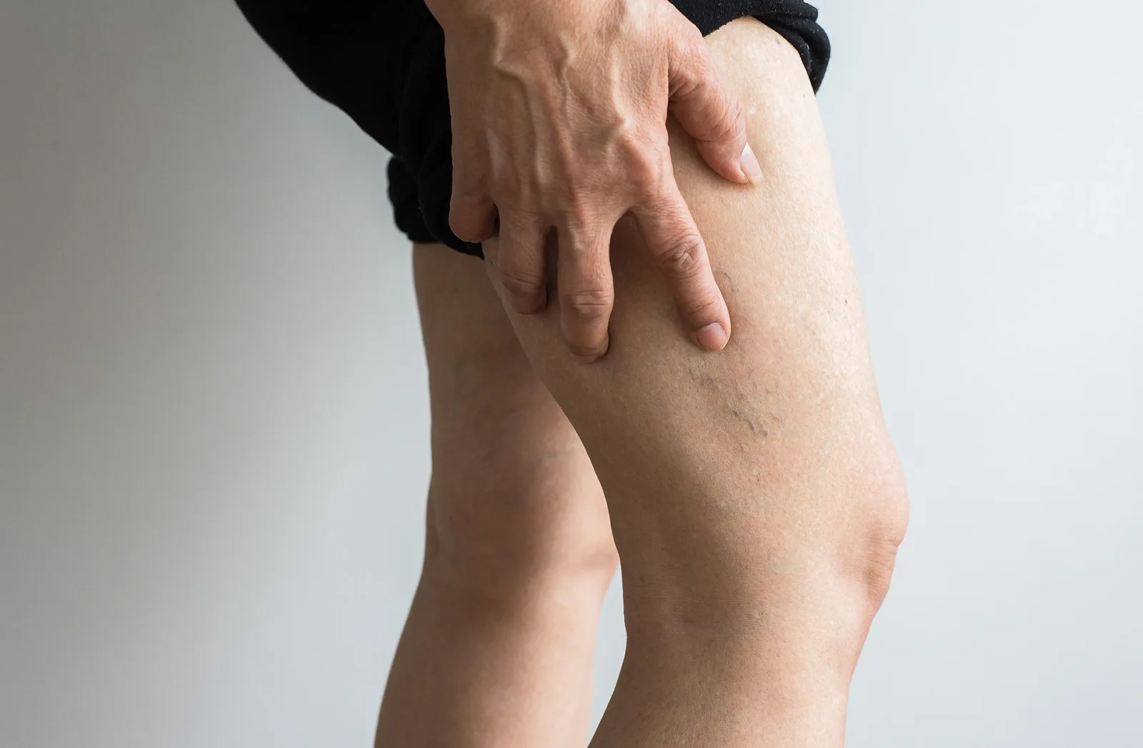 Leg Spider Vein Removal: Your Comprehensive Guide to