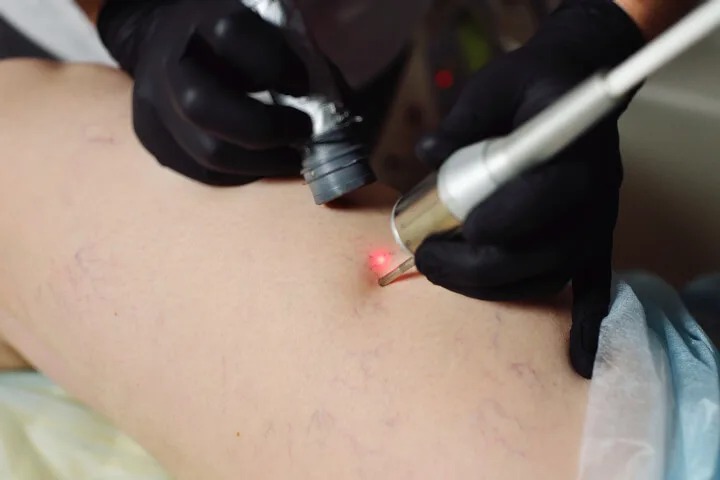 How Soon Can I See Results from Spider Veins Laser