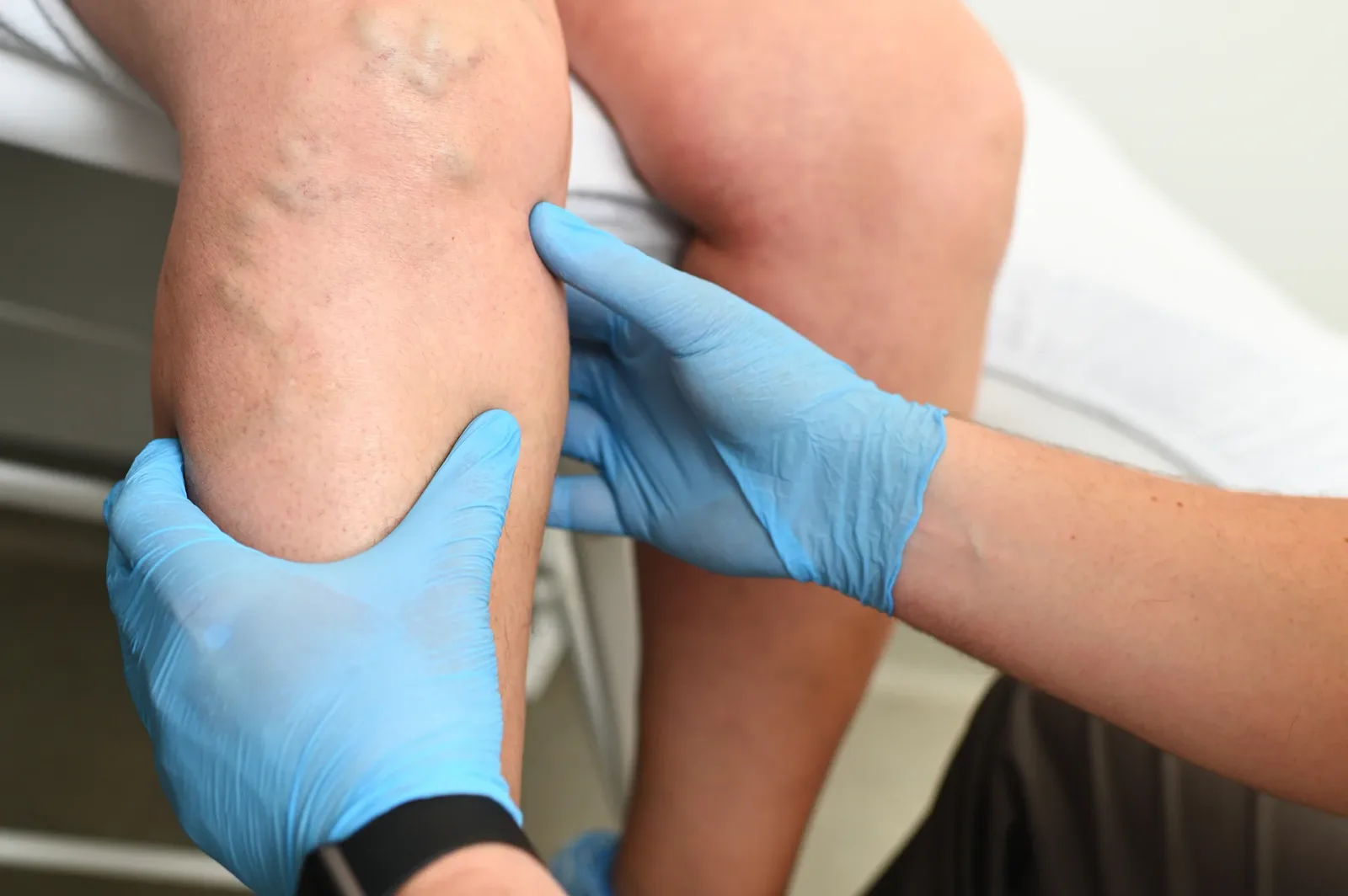 Is It Lymphedema, Pitting Edema, or Chronic Venous