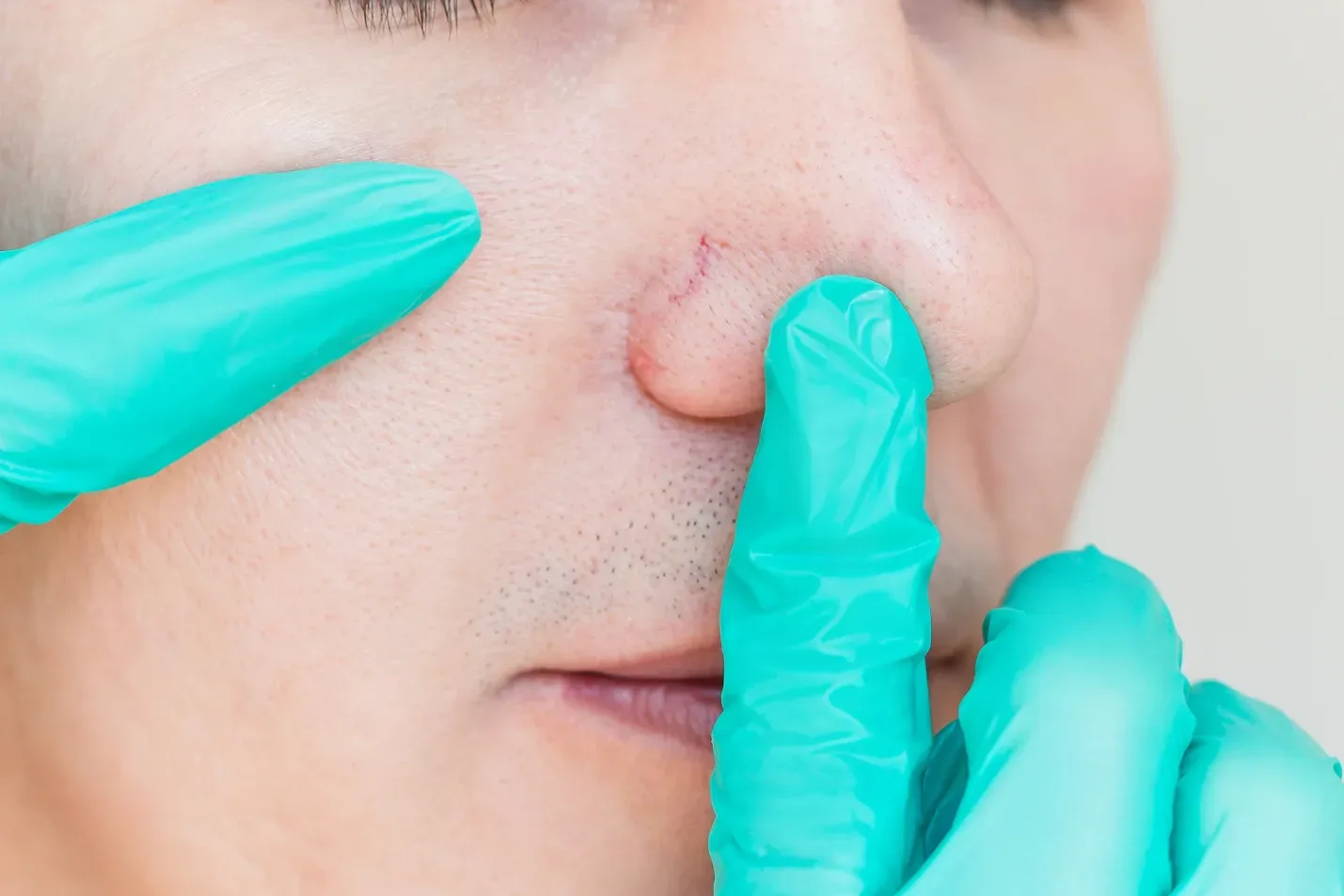 Nose Thread Vein Removal: Everything You Need to Know