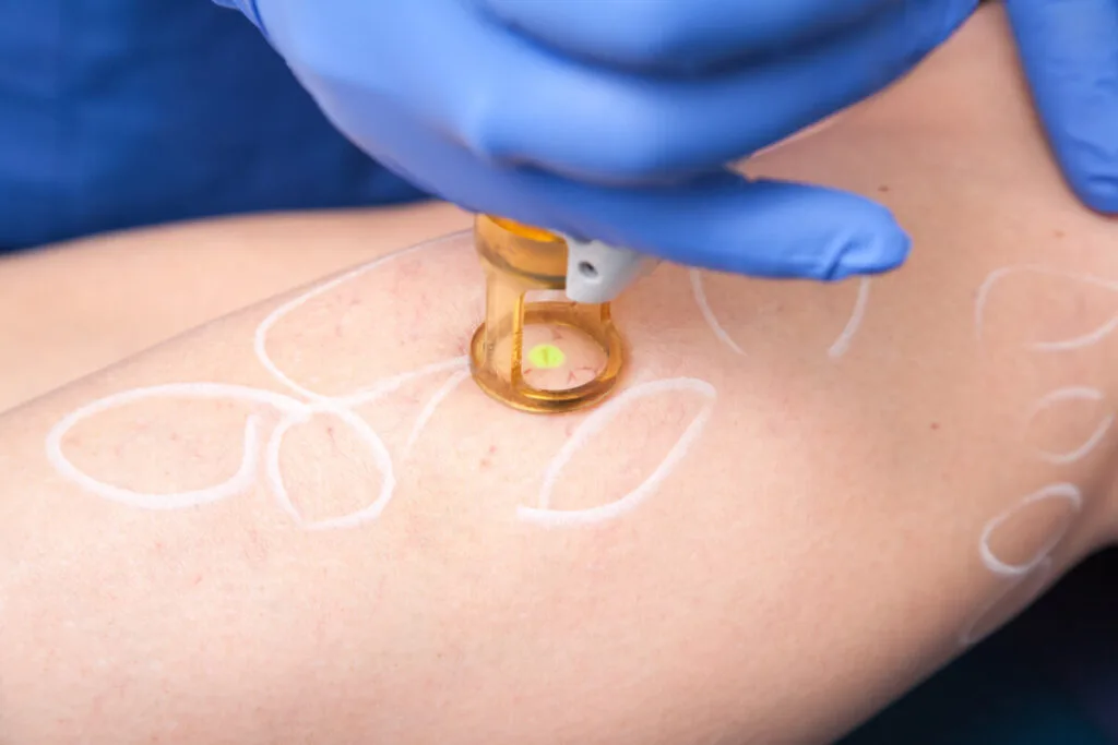 Removal of spider veins by laser treatment