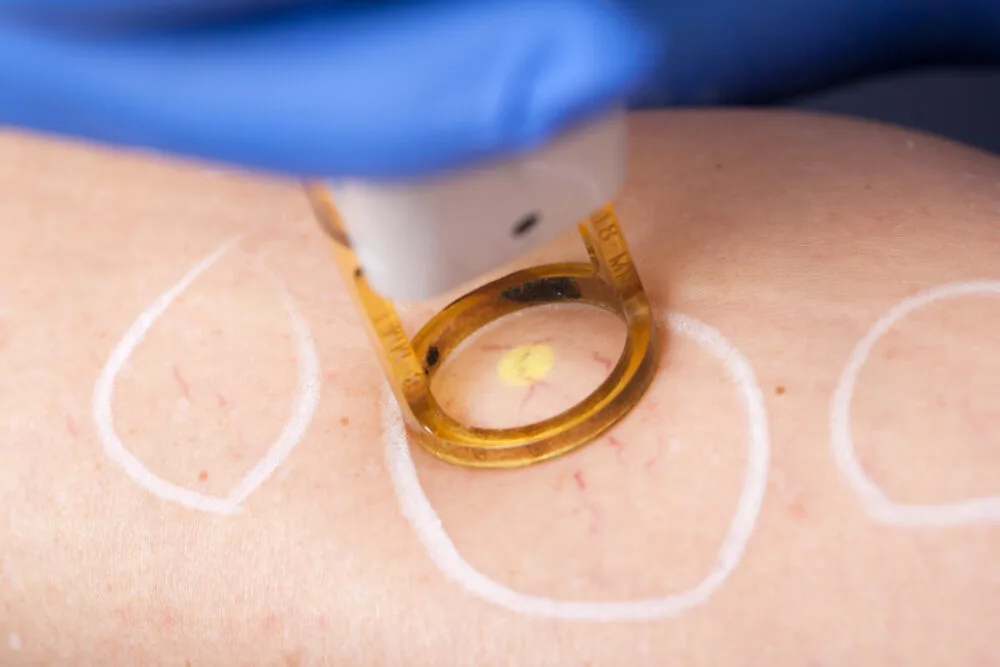 Is It Safe To Get Laser Therapy While on Antibiotics?
