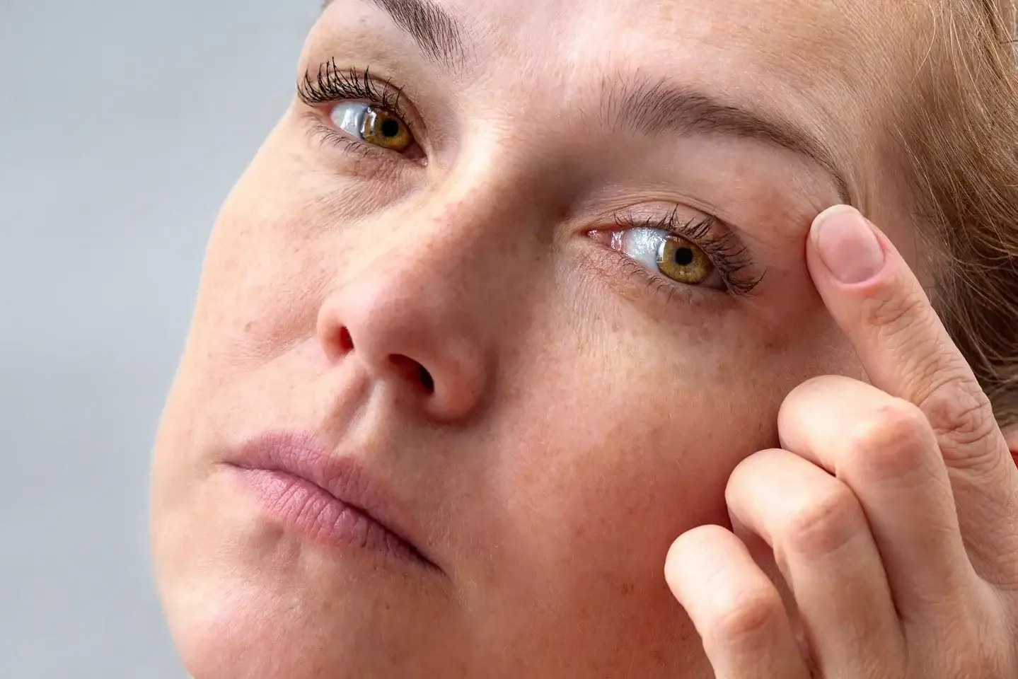 How to Get Rid of Spider Veins Below Your Eyebrow