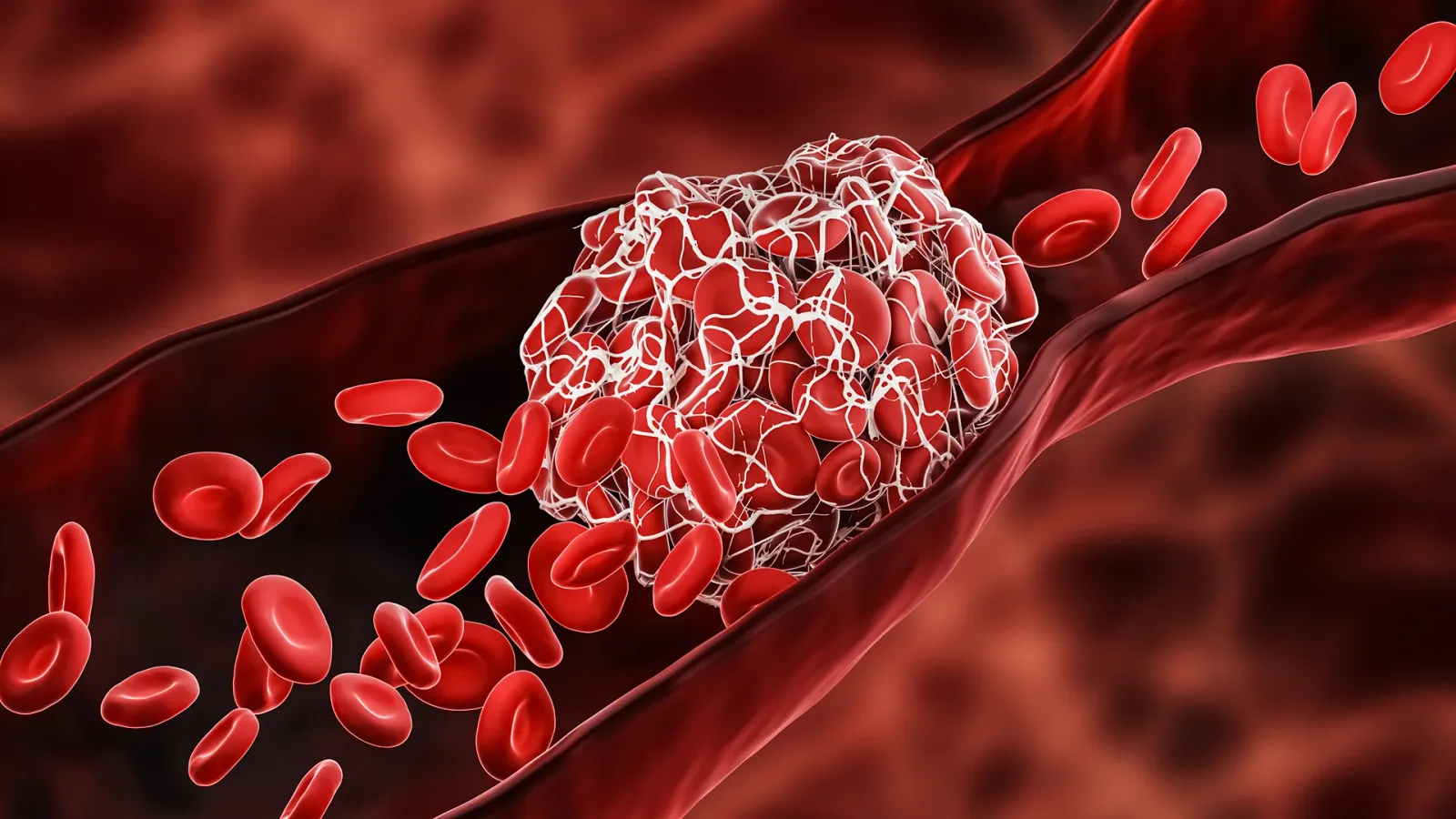 Superficial Thrombophlebitis vs Chronic Venous