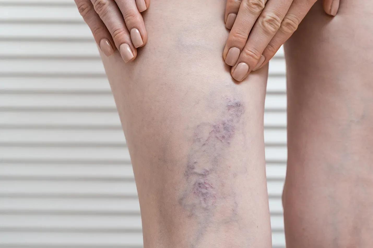 Telangiectasia Macularis Eruptiva Perstans (TMEP): What You