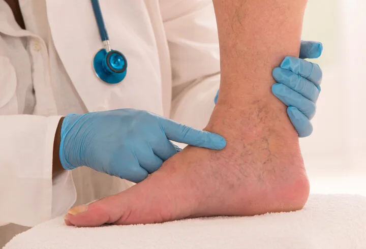 varicose veins on a person and doctor 