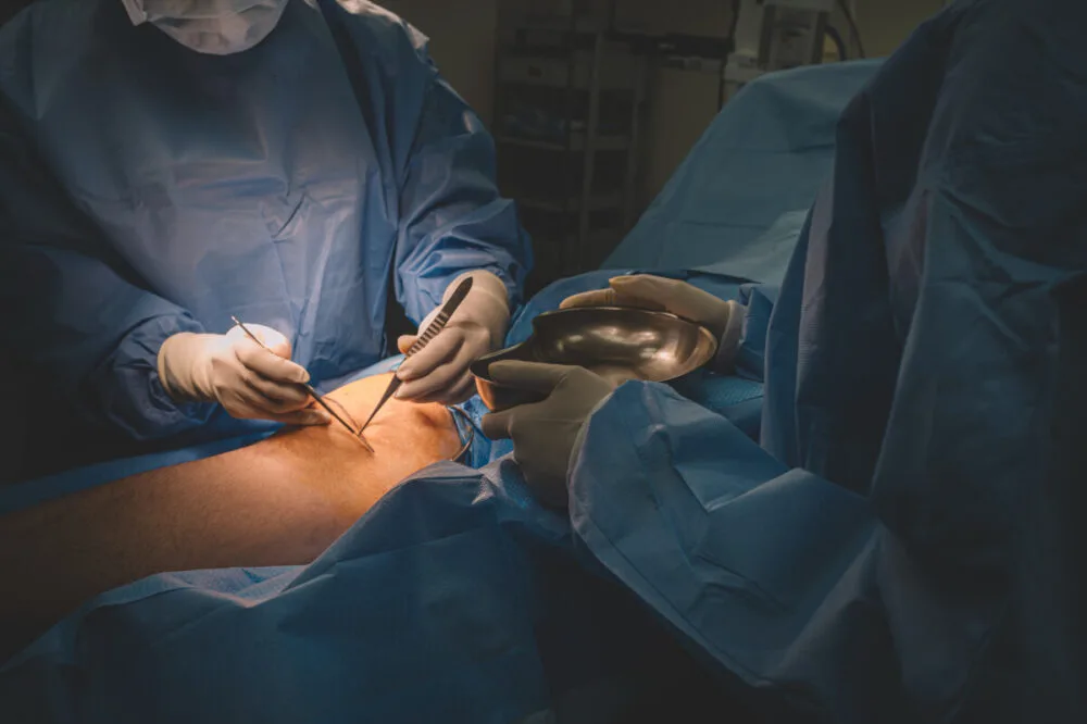 How Does Varicose Vein Surgery Affect The Lymphatic System?