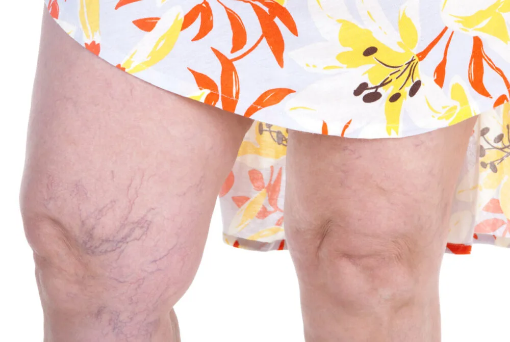 How to Get Rid of Spider Veins and Varicose Veins Naturally