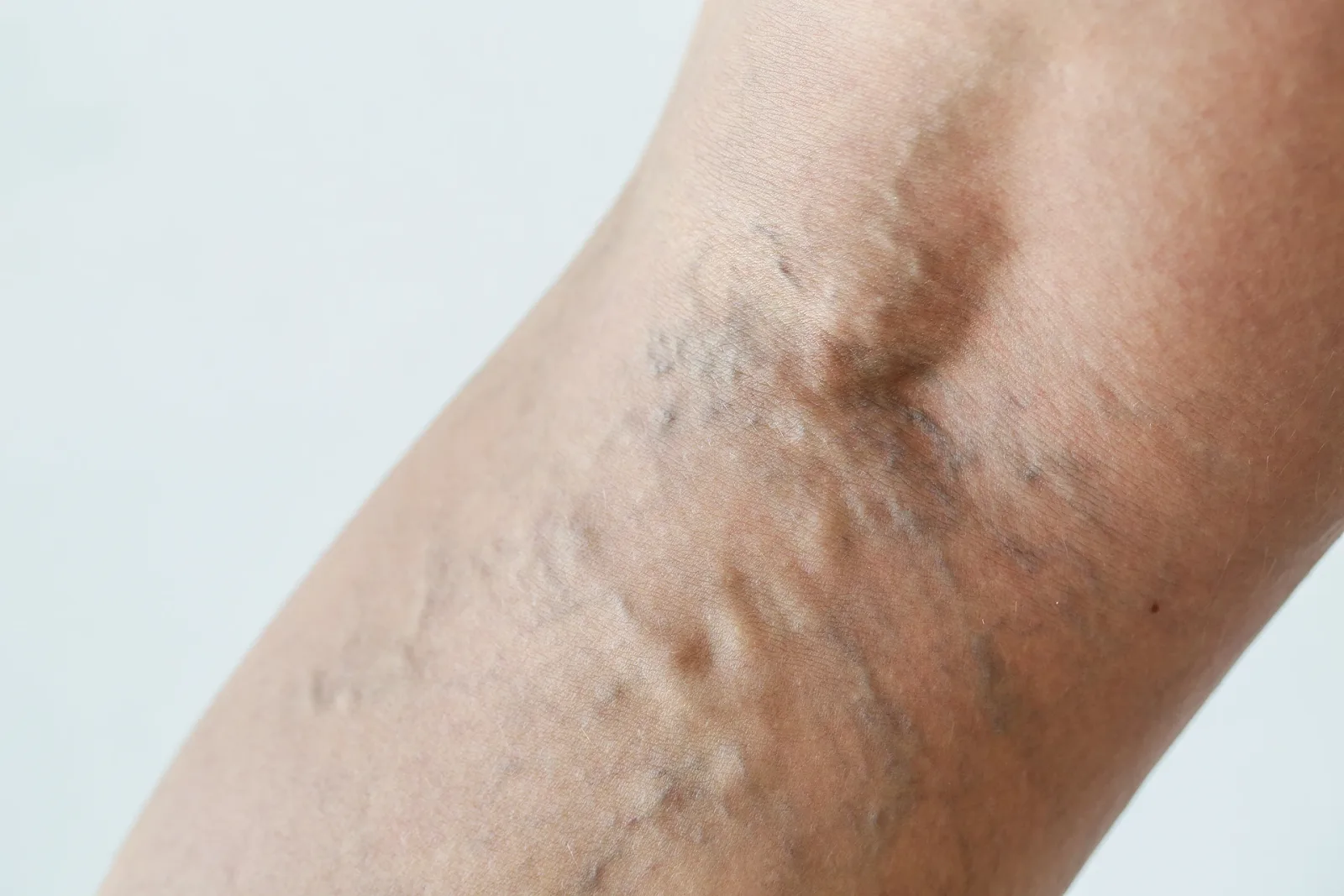 The Unexpected Relationship Between Vasculitis and Spider