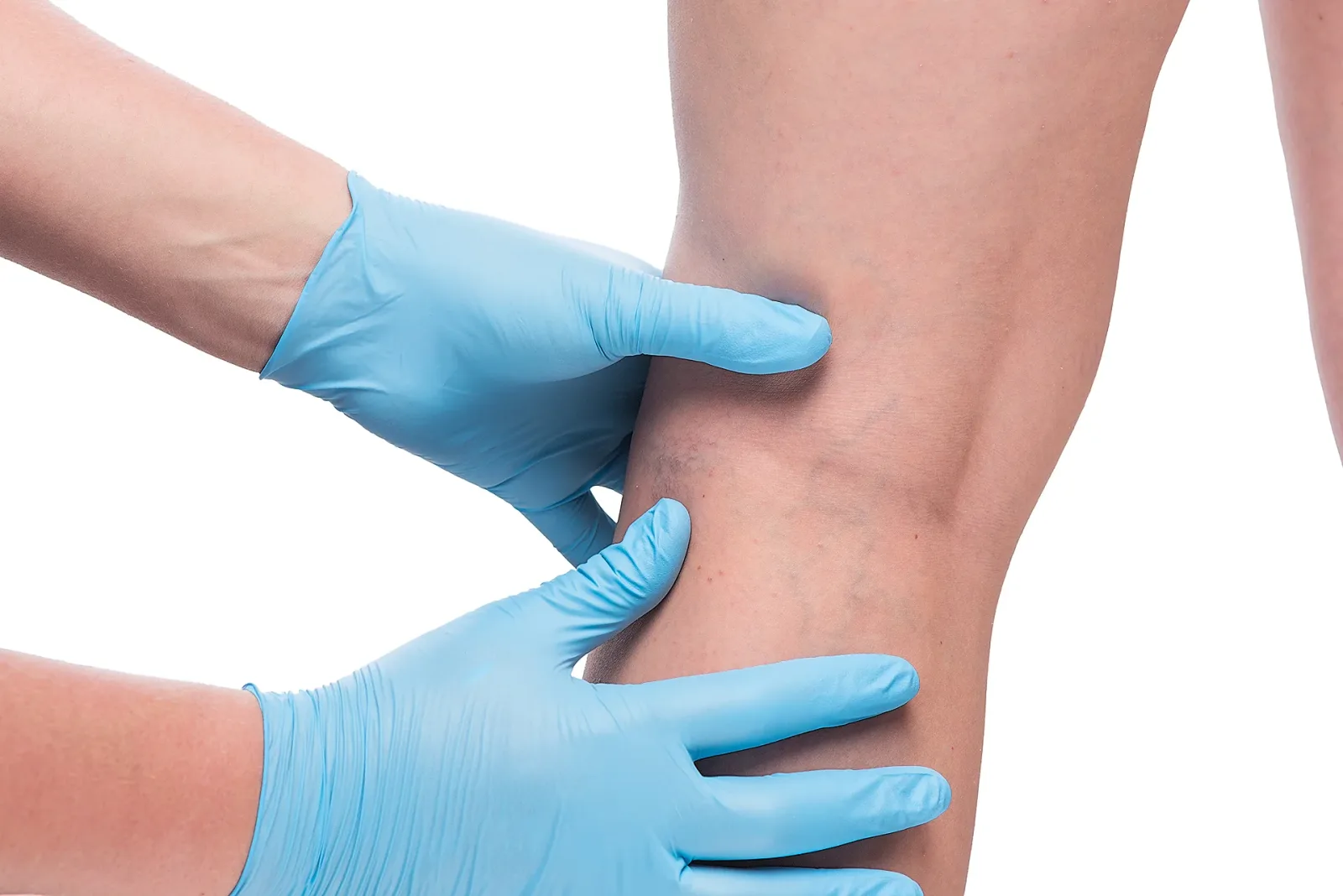 What are the Best Chronic Venous Insufficiency Treatment