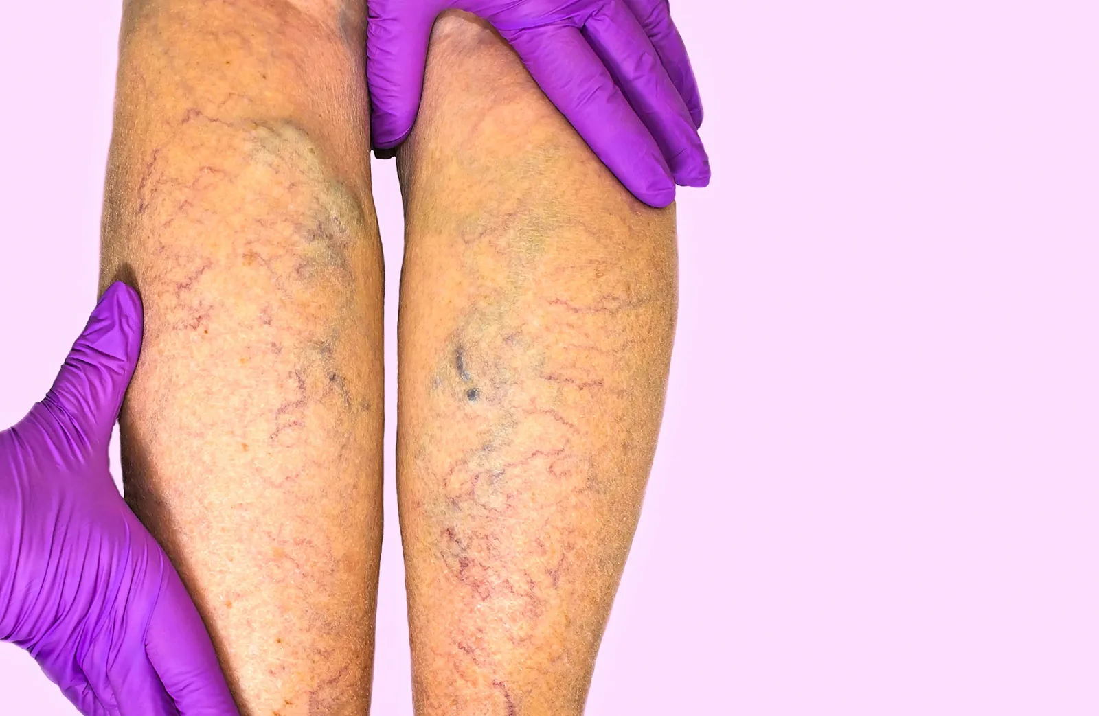 What Are The Best Treatments for Chronic Venous