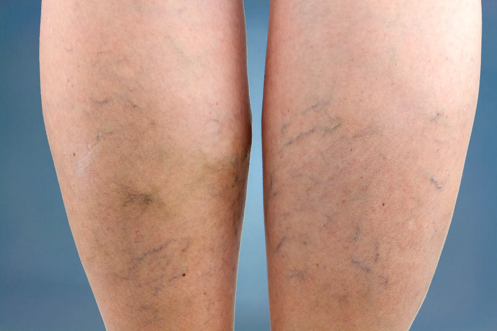 When To Worry About Spider Veins
