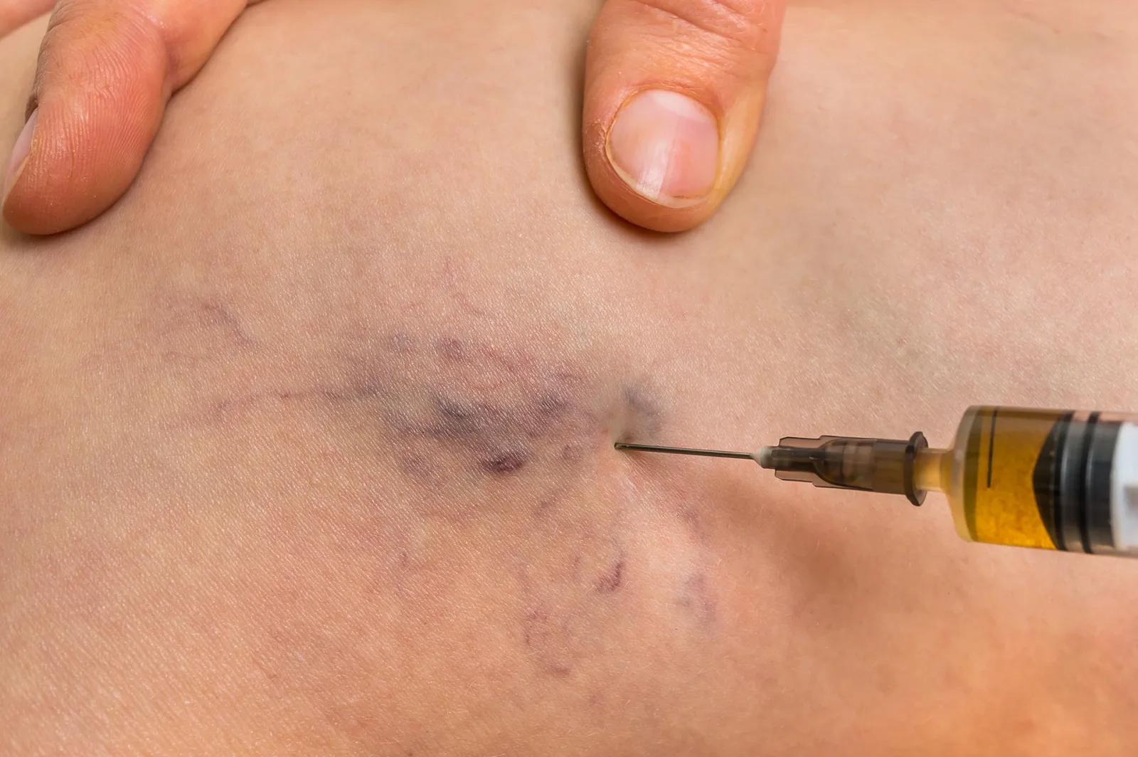 Why Do You Get Knots at the Injection Site When Treating
