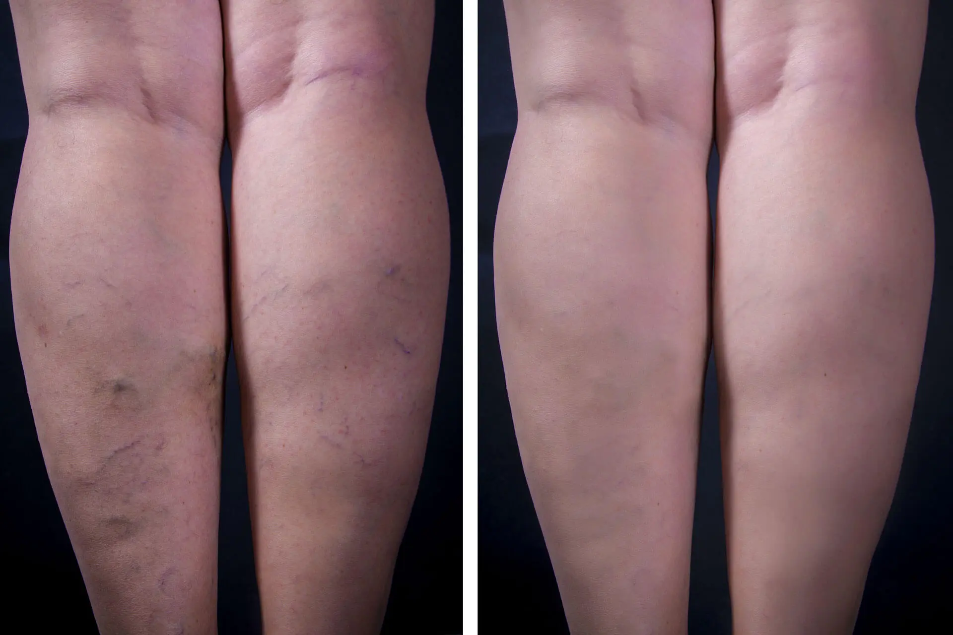 Before and after vein treatment result — spider veins on legs