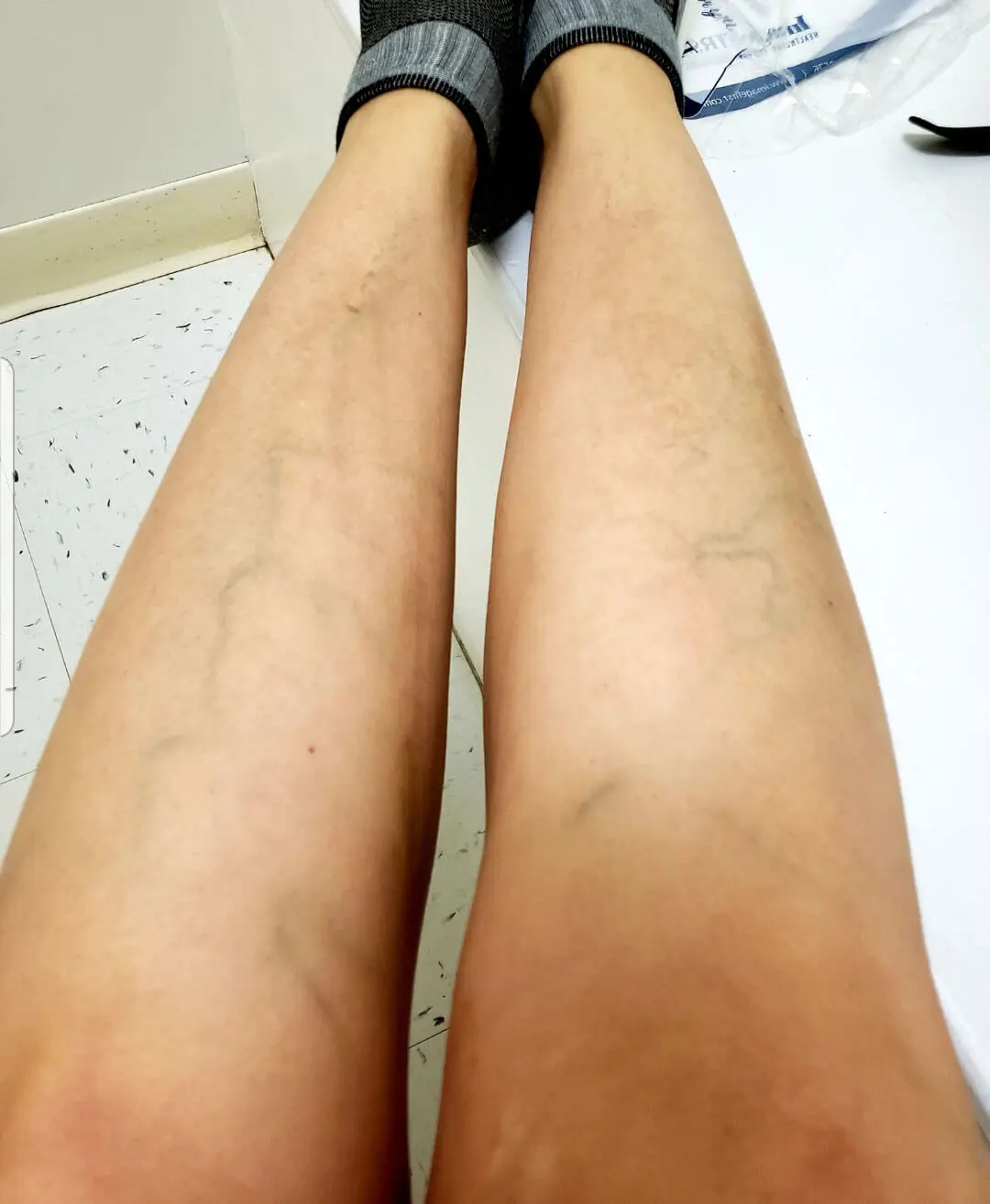 Before and after vein treatment result 4