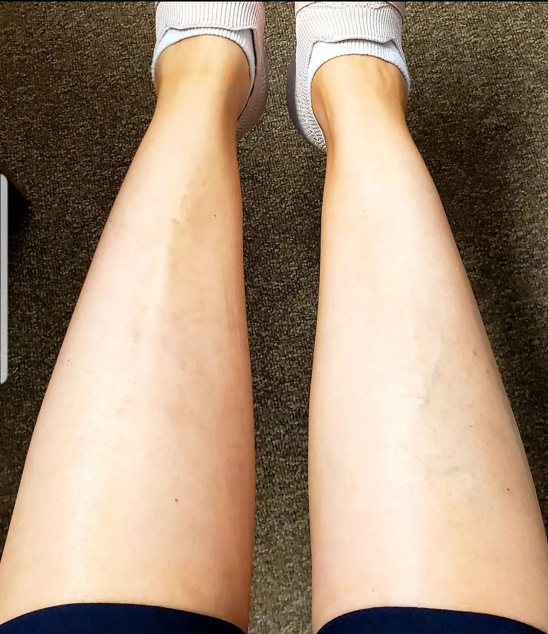 Before and after vein treatment result 6